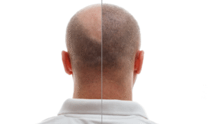 Can You Lose Transplanted Hair