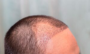 Most Advanced Technology for Hair Transplantation