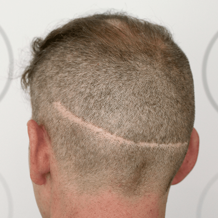Do-Hair-Transplants-Leave-Scars-720x720.png