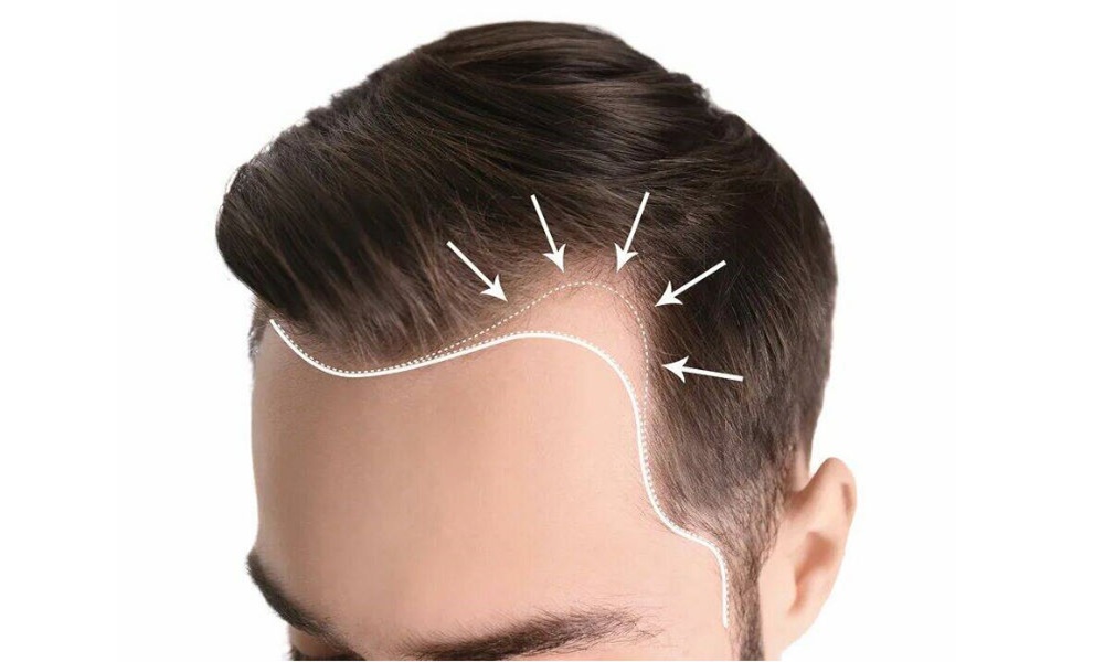 Hairline Design in Transplants: Where Art Meets Precision