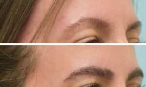 How Do Beard & Eyebrow Transplants Work?