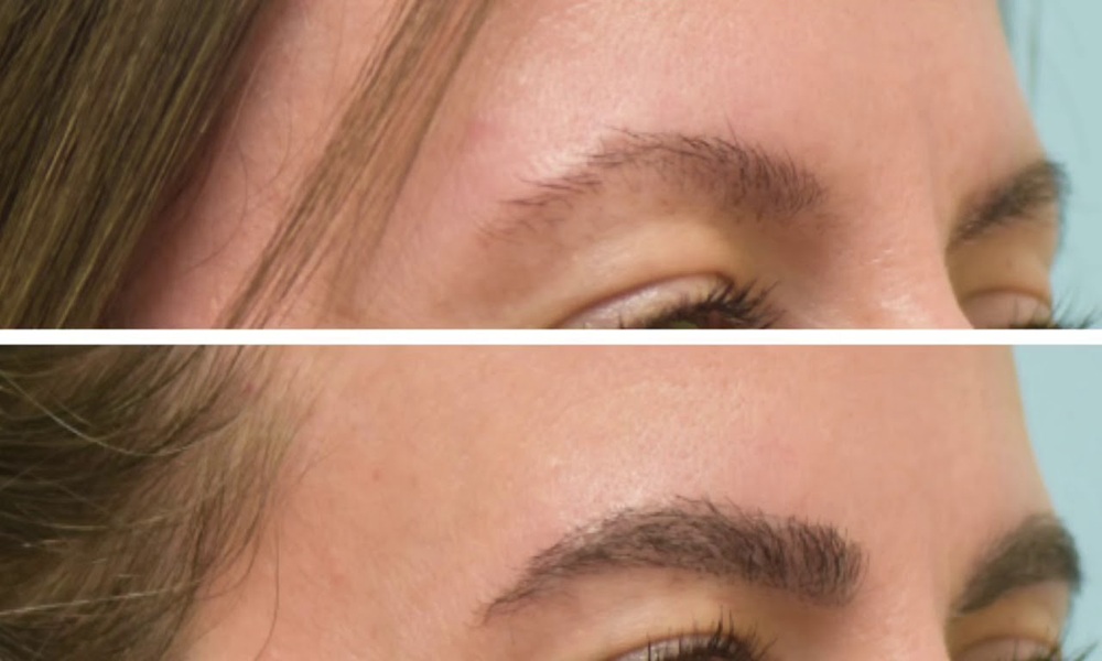 How Do Beard & Eyebrow Transplants Work?
