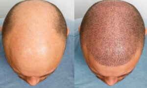 How Many Grafts Are Needed for a Full Head