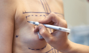 Male Chest Contouring: Gynecomastia Explained