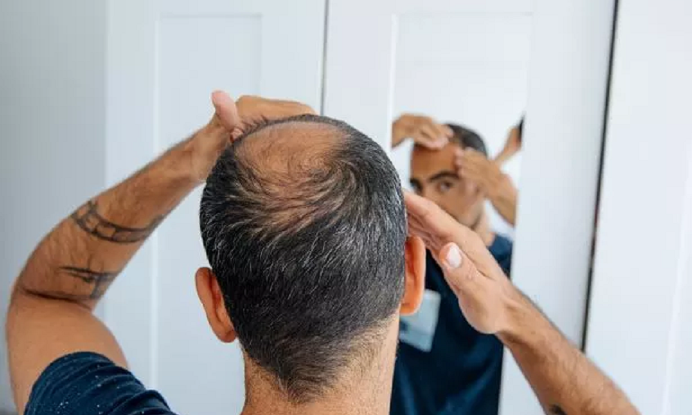 Cheap And Best Hair Transplant in Islamabad