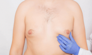 Gynecomastia Surgery Recovery Your Guide to a Fast, Smooth & Safe Healing Process