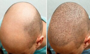 Cost of Hair Transplant in Islamabad
