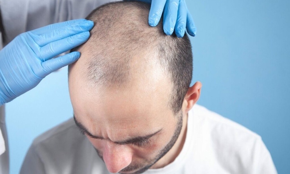 Hair Transplant in Islamabad: Best Techniques, Cost & Results in 2026