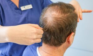 Why Didnt My Hair Transplant Work